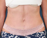 Feel Beautiful - Tummy Tuck Times Two - After Photo